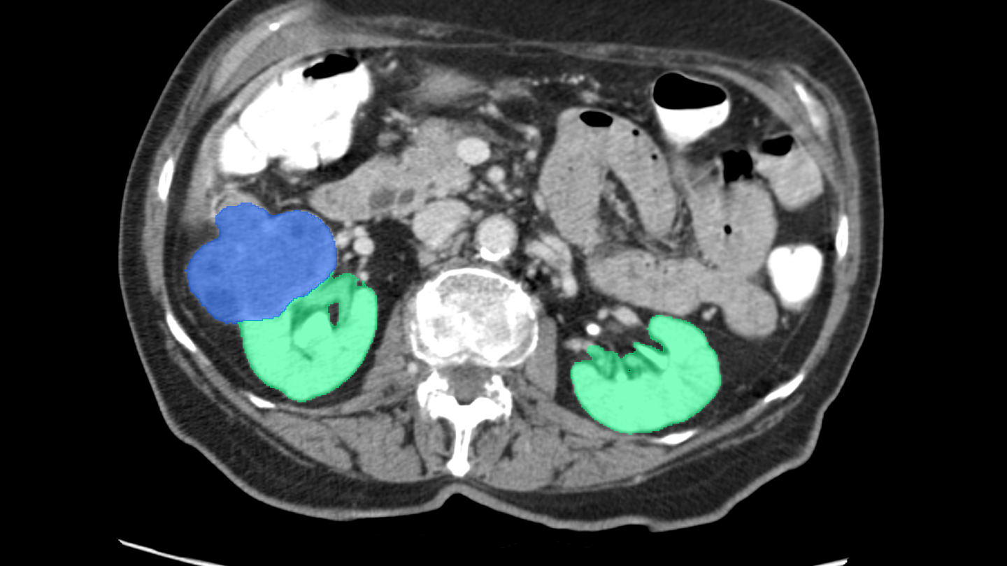 AI identifies cancer in PET scan diagnostic image